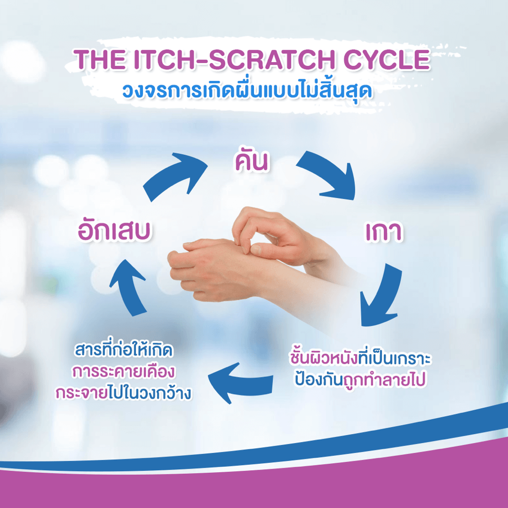 วงจรการเกิดผื่นแบบไม่สิ้นสุด